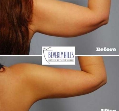 Beverly hills md coupon code